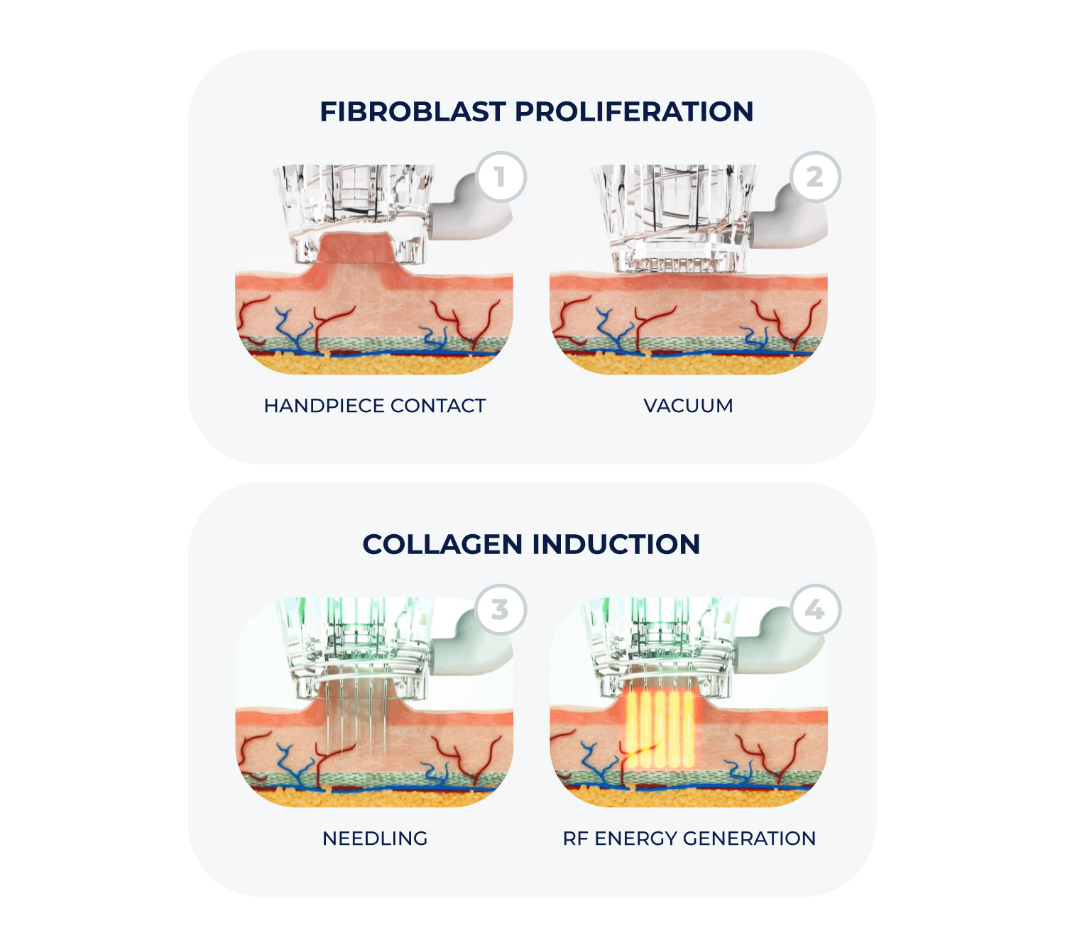 Zastosowanie urządzenia do radiofrekwencji mikroiglowej z Vacuum Recell Ice