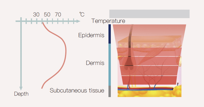 IPL – Intense Pulsed Light